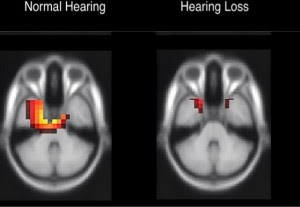 brain function decline do to hearing loss brain scan
